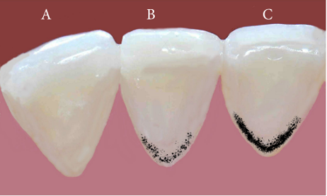 Cosa sono le Black Stains?